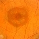 Bull's Eye Maculopathy